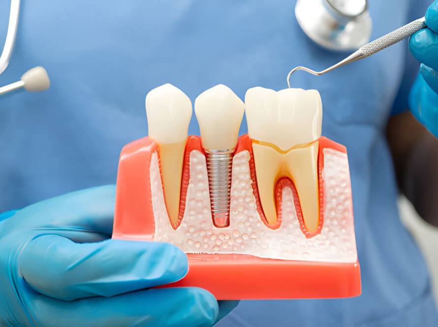 how to care for dental implants.
