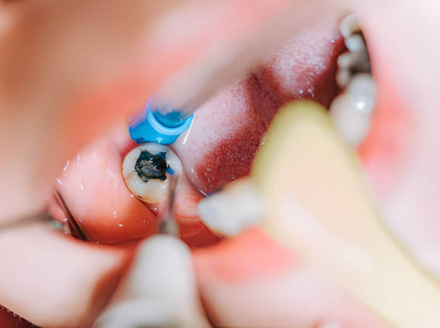 Dental Fillings Near Me