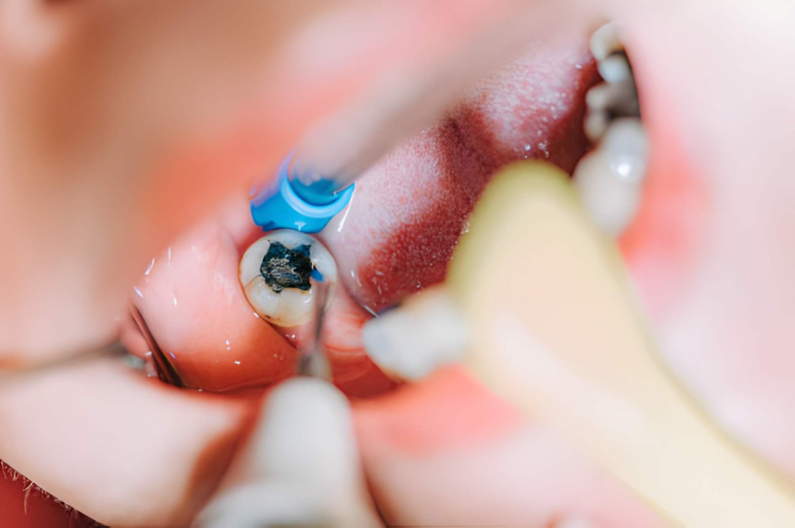 Dental Fillings Near Me